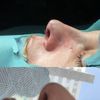 Perito cirugía estética, rinoplastia
