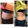 Decepcionada abdominoplastia