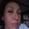Radiesse  sobre rostro