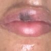 Aumento de labios doloroso