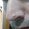 ¿Como se queda la piel después de afeitar un lunar abultado localizado en la nariz?
