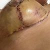 Experiencia y dudas de mastopexia con protesis + malla galaflex