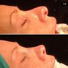 Me voy a hacer una rinoplastia