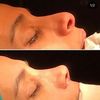 Me voy a hacer una rinoplastia