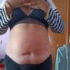 Mi abdominoplastia noviembre 2021