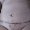 Mi abdominoplastia noviembre 2021