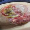 Herida en post operatorio en una reducción de mama