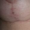 Mastopexia sin implantes