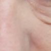 EDEMA POR AH Y BLEFAROPLASTIA