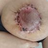 Mastopexia periareolar