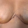 Mastopexia con pliegues