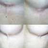 Alguien ha sufrido del sindrome de Mondor?