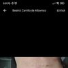 Ombligo feo después de abdominoplastia