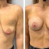 Aumento de pecho y mastopexia, y dolor muscular pectoral y de la axila
