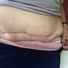 op para retirar "culos de pollo" y elevar el pubis