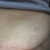 op para retirar "culos de pollo" y elevar el pubis