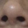 La punta de mi nariz después de una Rinoplastia 