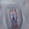 Operada de labioplastia el 17 de septiembre. Deseando ver el resultado final  !