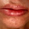 Boca deformada tras lipotransferencia de labios con grasa autóloga