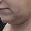 TRATAMIENTO PARA FLACIDEZ Y TRATAMIENTO PARA GRASA