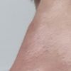 Rinoplastia con imperfección