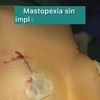 Lipofilling de mamas