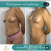 Lipofilling de mamas
