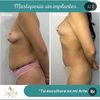 Lipofilling de mamas