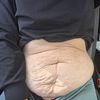 Abdominoplastia más aumento de senos
