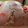Infecciones en cicatrices en pecho