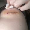 Me toca pagar la recolocación del implante