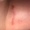 Estoy preocupada por mis Cicatrices de operación de pecho