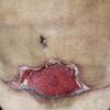Necrosis en abdominoplastia