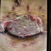 Necrosis en abdominoplastia
