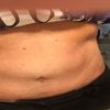 Fibrosis después de absominoplastia