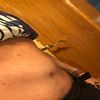 Fibrosis después de absominoplastia