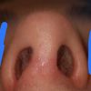 Columela colgante y asimetría tras rinoplastia
