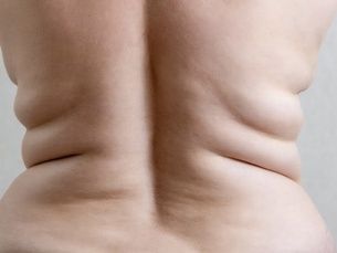 Liposucción de Precisión