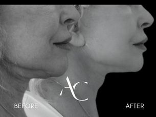 LIFTING FACIAL DESDE 7.000€
