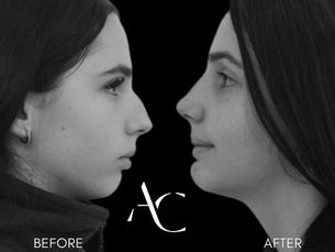 RINOPLASTIA DESDE 5.000€