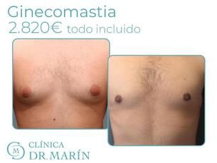 Ginecomastia 2.820€