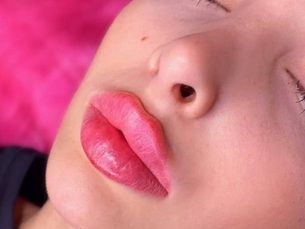 Relleno de labios con ácido hialurónico