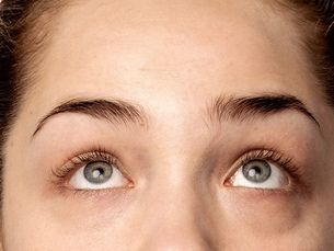 Blefaroplastia, tratamiento periocular