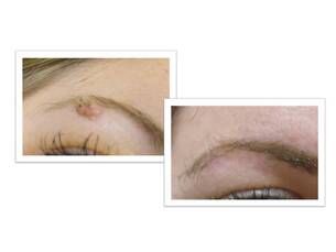 Elimina verrugas y otras imperfecciones de la piel con láser. desde 90€