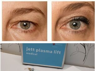 Lifting de párpados mediante tecnología plasma ¡Blefaroplastia sin cirugía