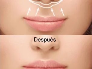 LIP-LIFT (Acortamiento del Labio Superior)