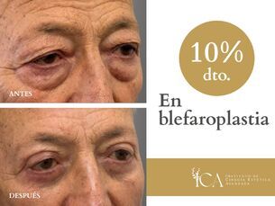 ¡Rejuvenece tu mirada con un 10% de descuento en tu blefaroplastia!