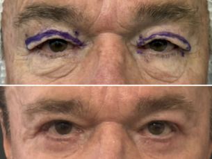 BLEFAROPLÁSTIA SUPERIOR Y/O INFERIOR