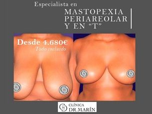 Mastopexia Periareolar y en T Desde 4.680 €