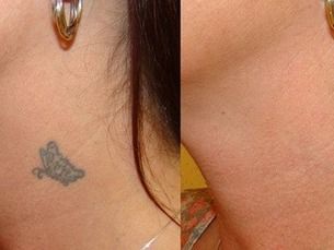 Elimina los tatuajes que no te gustan con un 30% de descuento